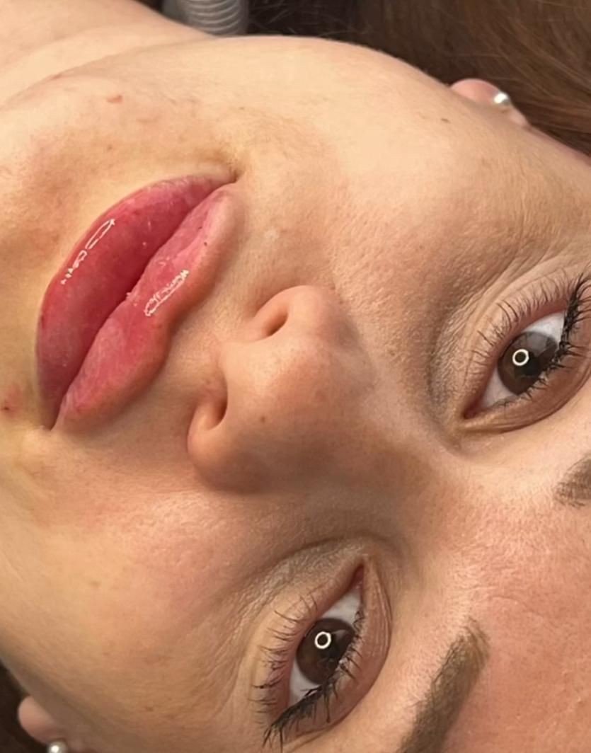 Woman having lip filler treatment