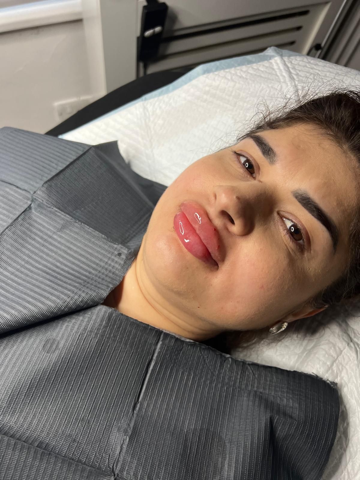 Lady having fillers