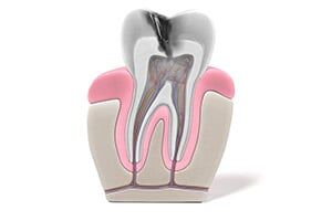 Root Canal Treatment - Saint John, IN - Indiana Implants & Dentistry An illustration of a tooth in need of emergency dentistry services near St. John, IN