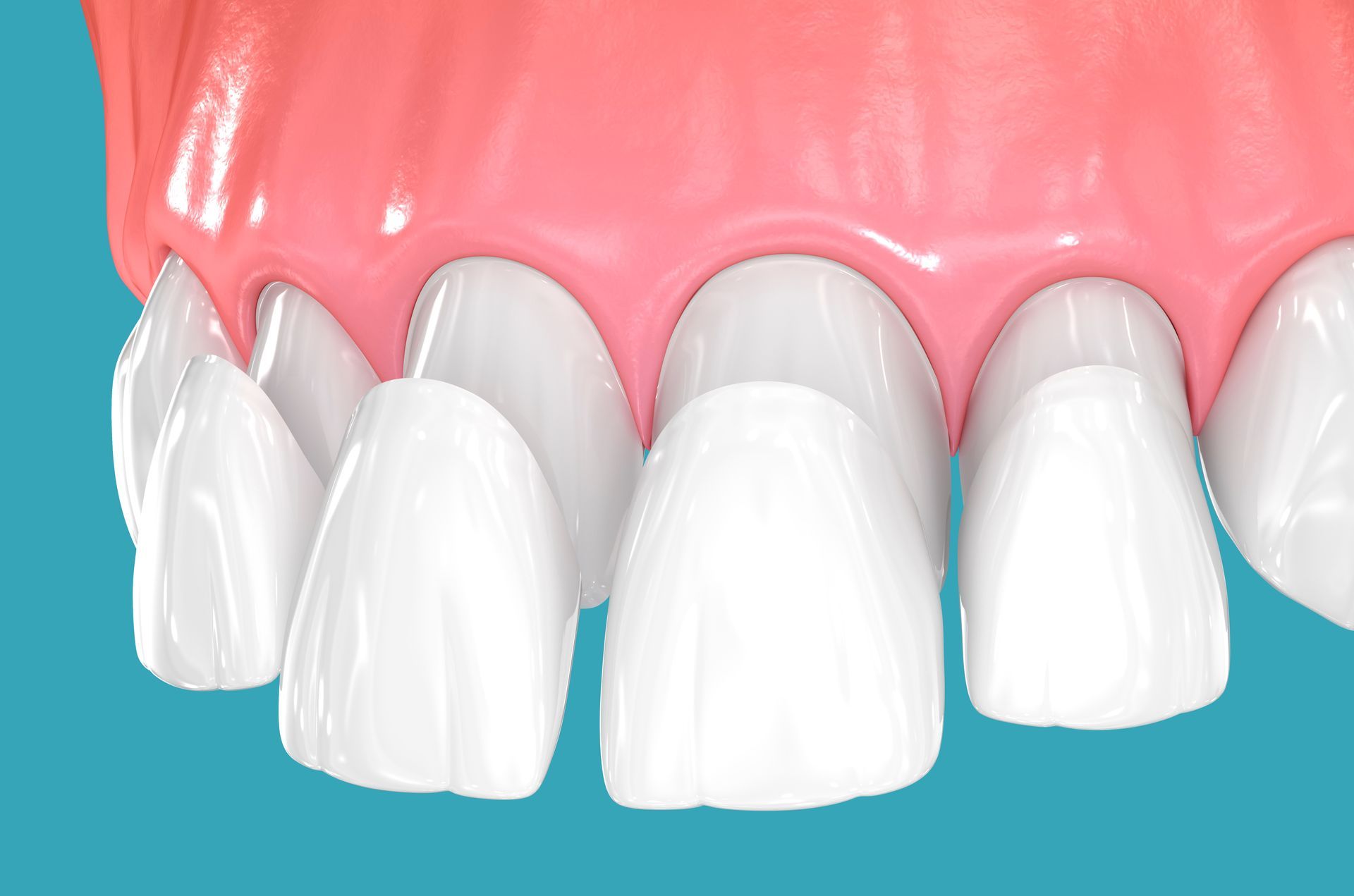 Dental veneers on blue background. Dental veneers on blue background.