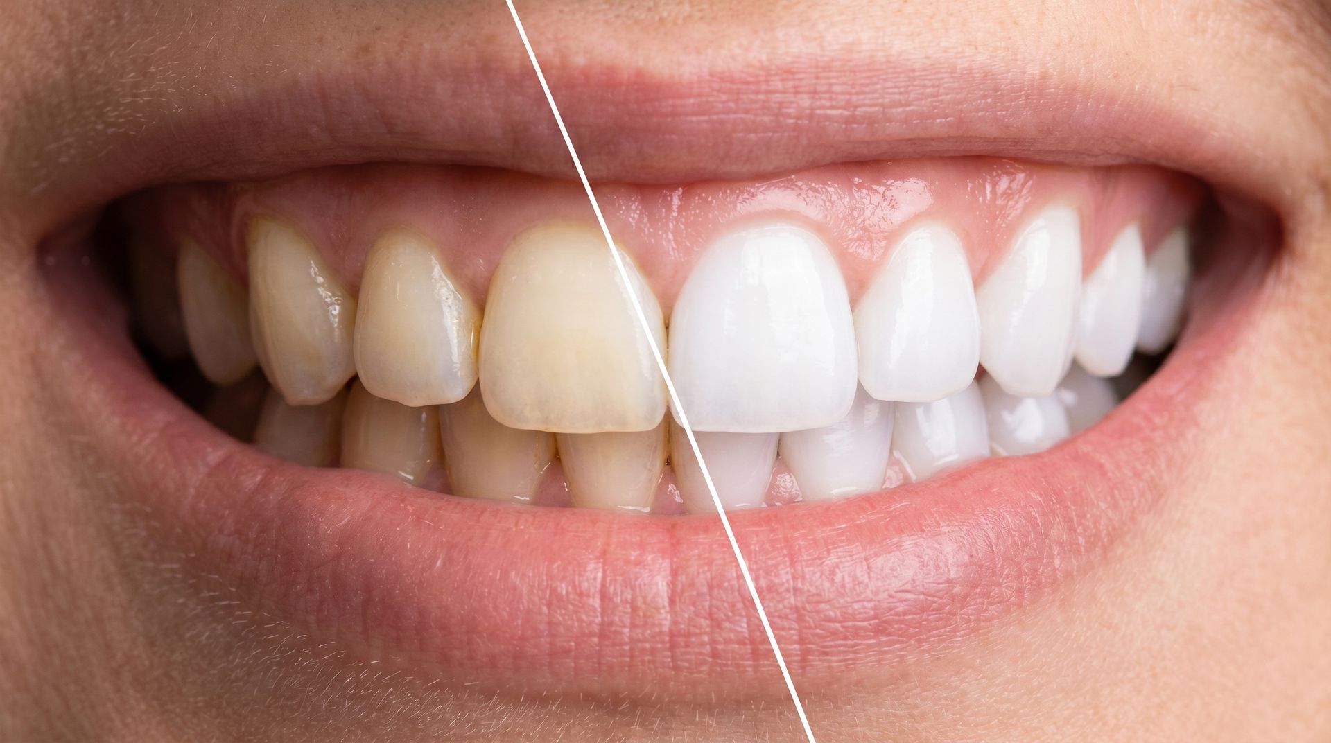 Dental veneers on blue background. Close-up of a smiling mouth with a visible before-and-after teeth whitening contrast, divided by a diagonal line