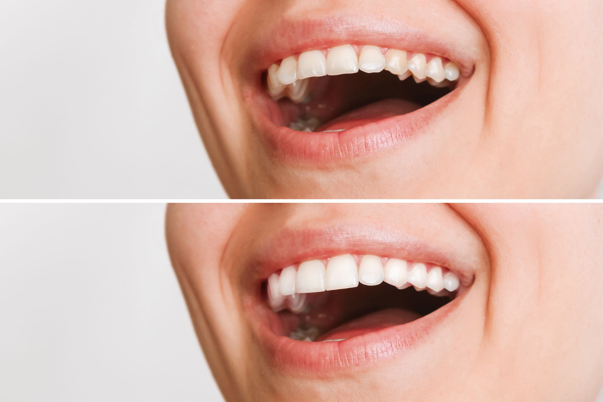 Cropped shot of a young caucasian smiling woman before and after veneers are installed isolated