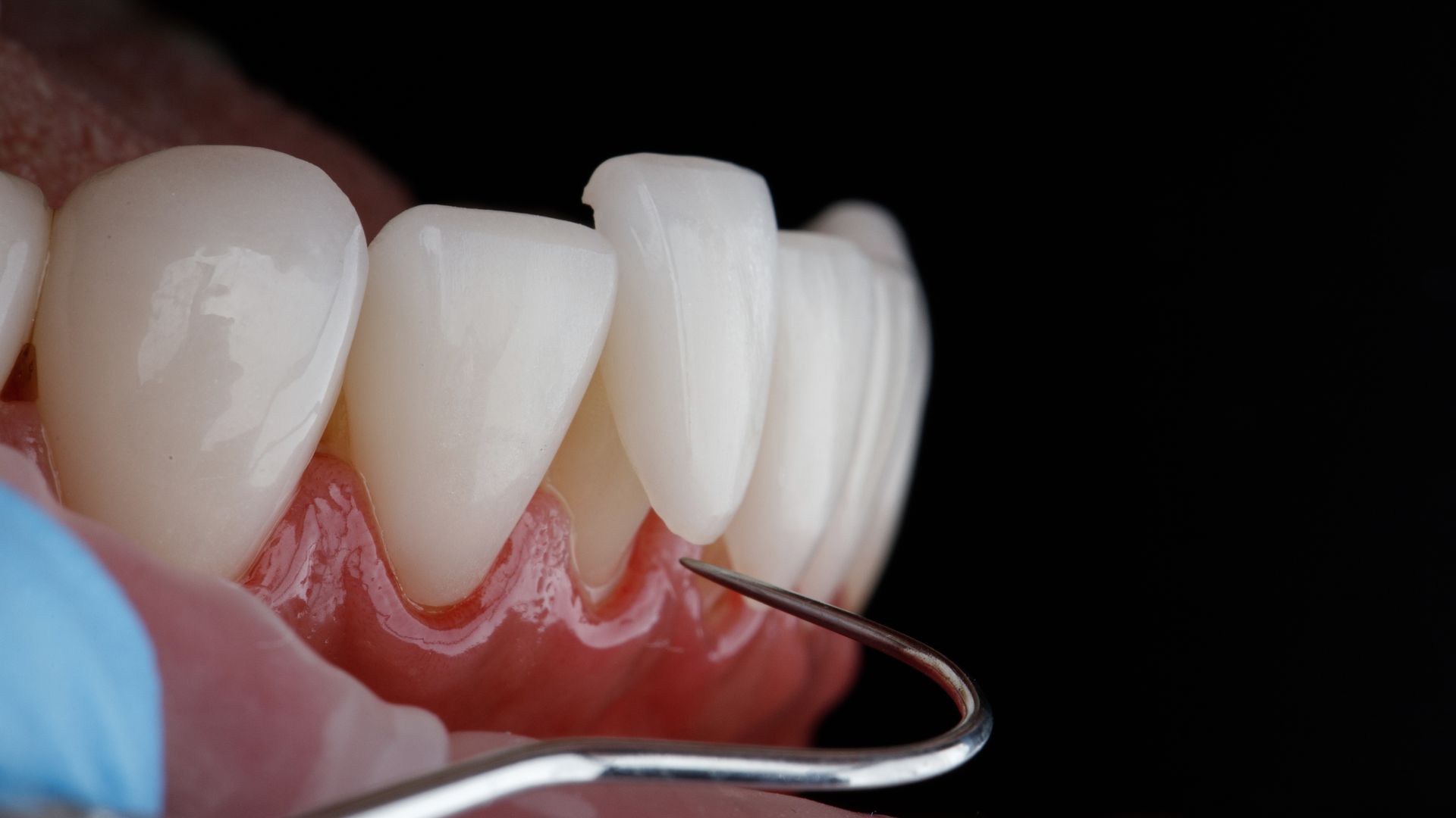 Tooth being cleaned with a dental scaler near the gumline
