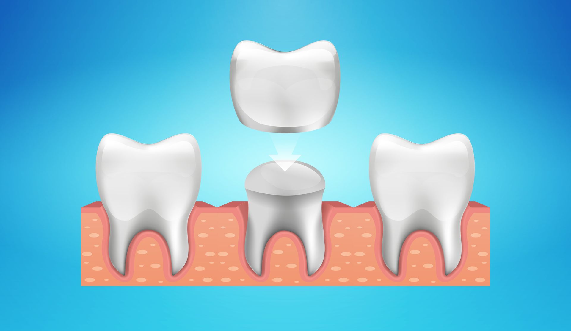 Dental Crowns - Highland, IN - Indiana Implants & Dentistry Dental Crowns - Highland, IN - Indiana Implants & Dentistry