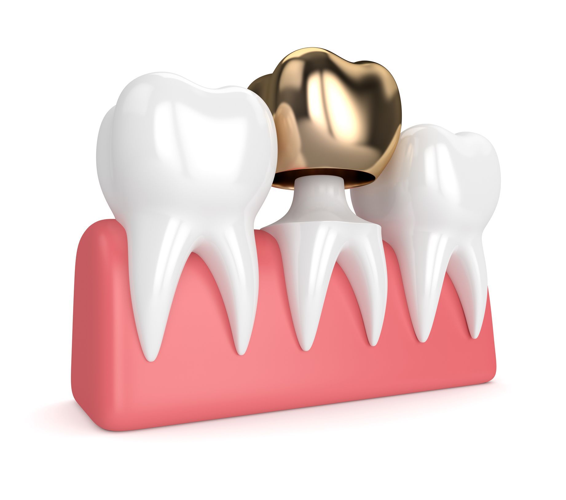 Dental Crowns - Dyer, IN - Indiana Implants & Dentistry Dental Crowns - Dyer, IN - Indiana Implants & Dentistry