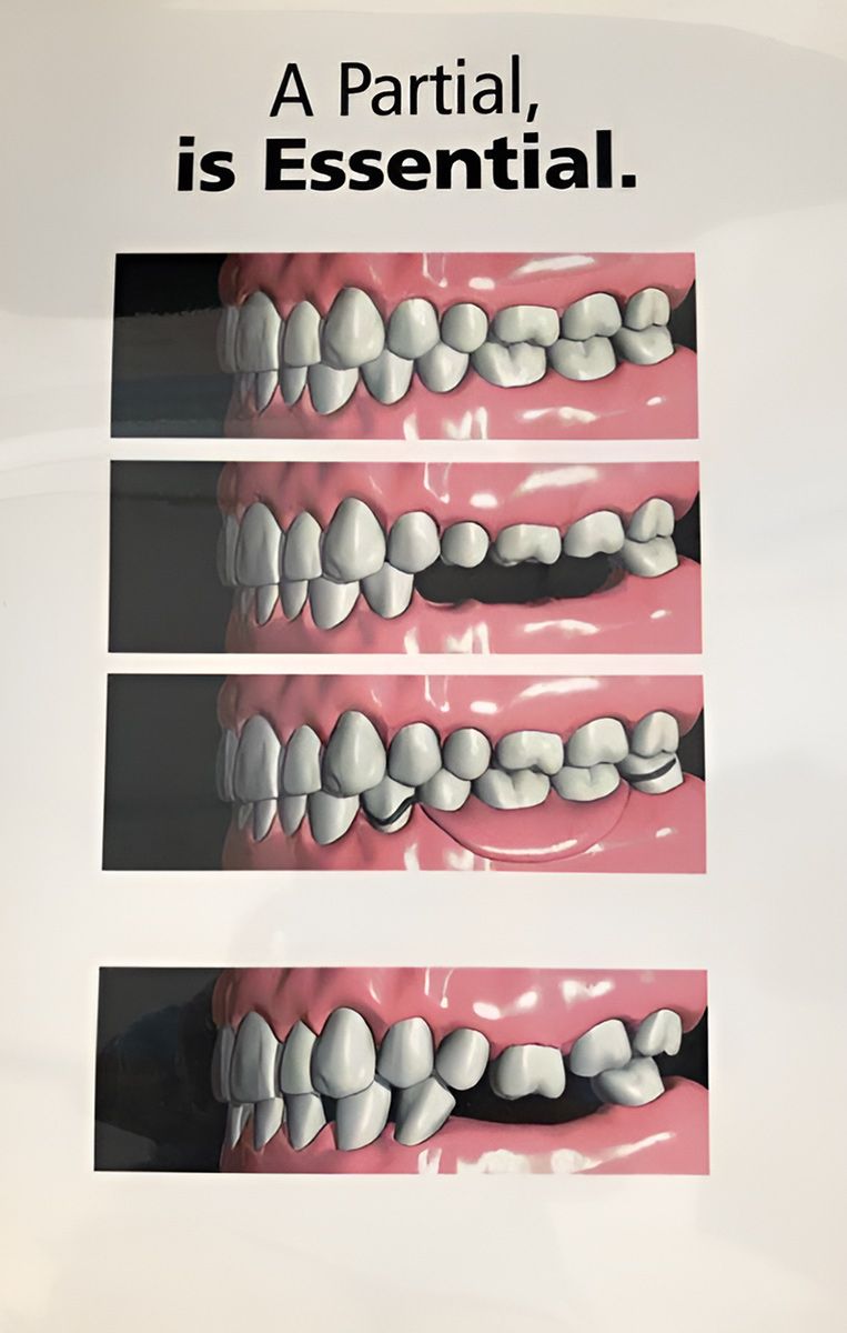 Four Side-view Illustrations of Teeth — Central Coast Denture Clinic Erina In Erina, NSW