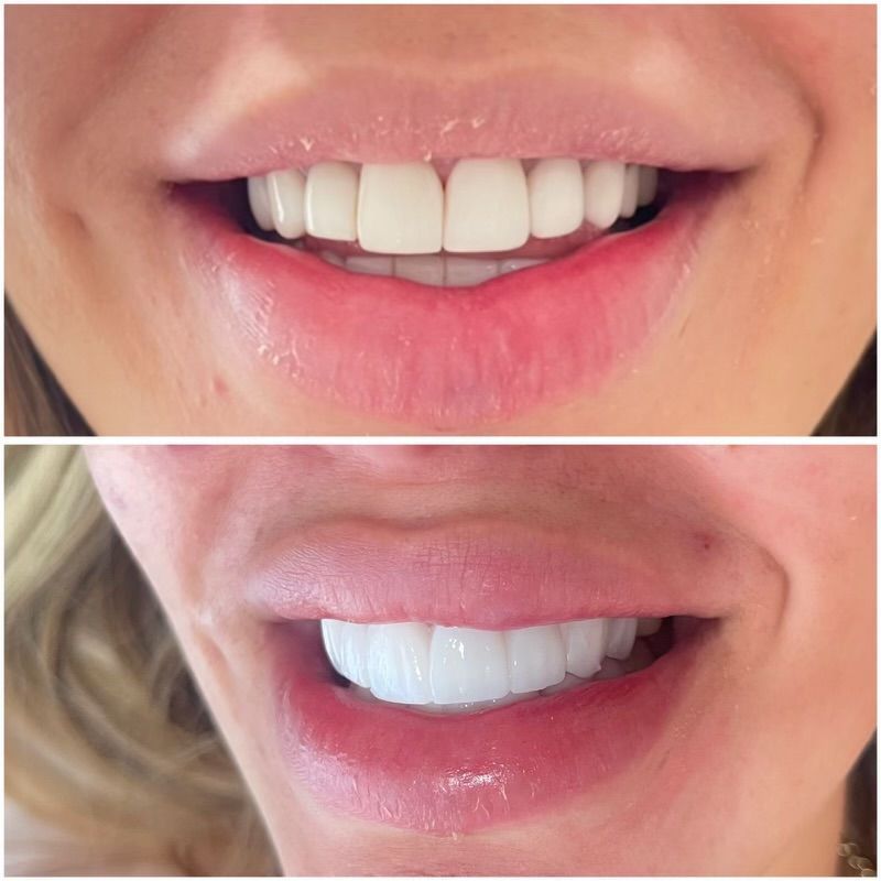 A before and after picture of a woman 's teeth.