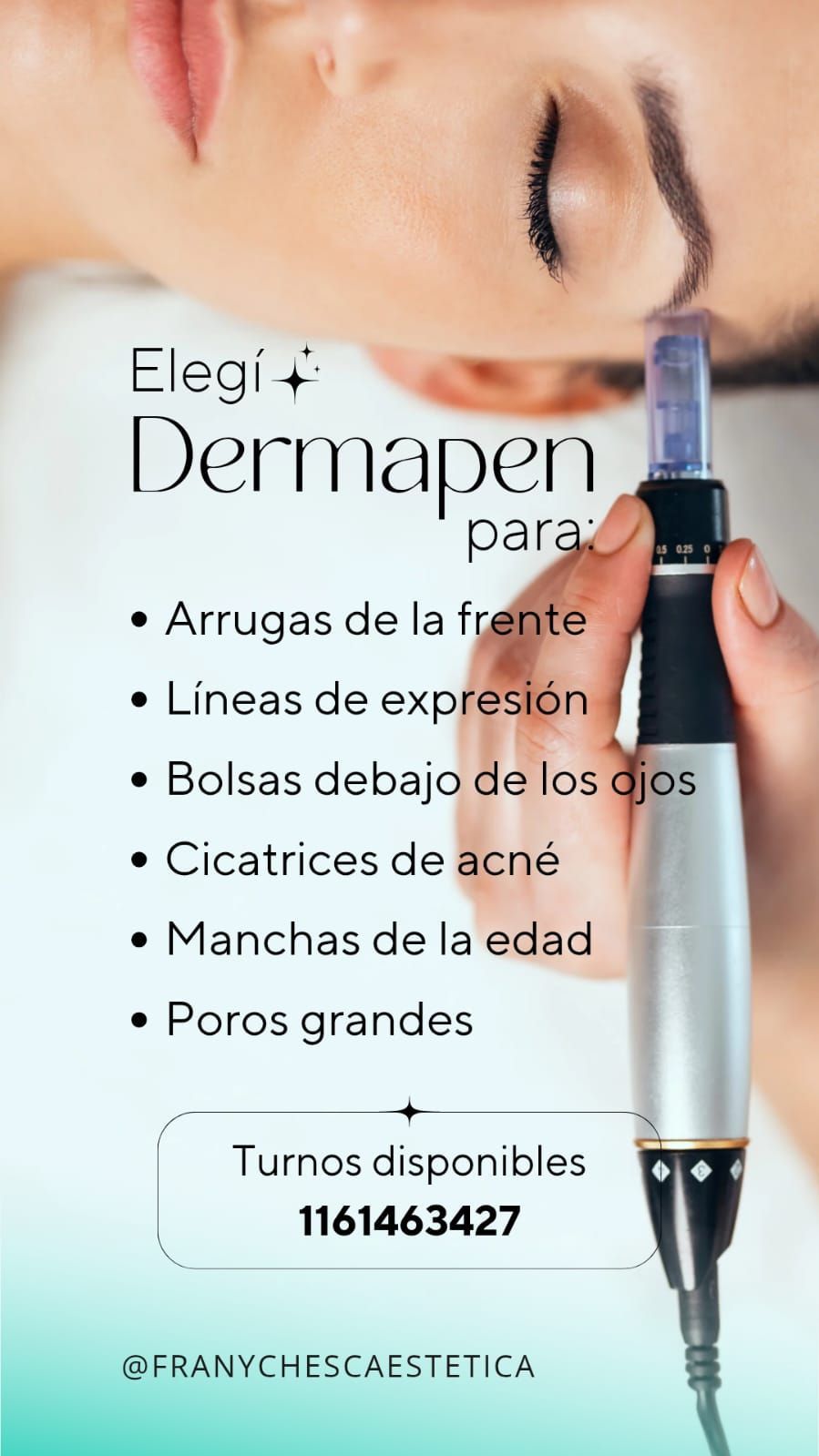 Anuncio con el rostro de una mujer y un dispositivo Dermapen para tratamientos de la piel; arrugas, cicatrices de acné, etc