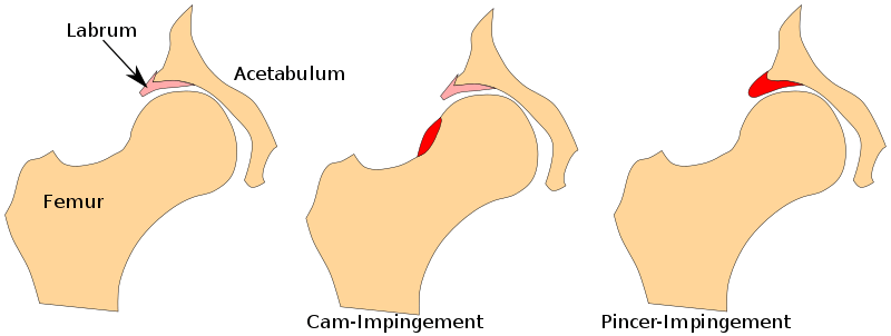 hip pain
