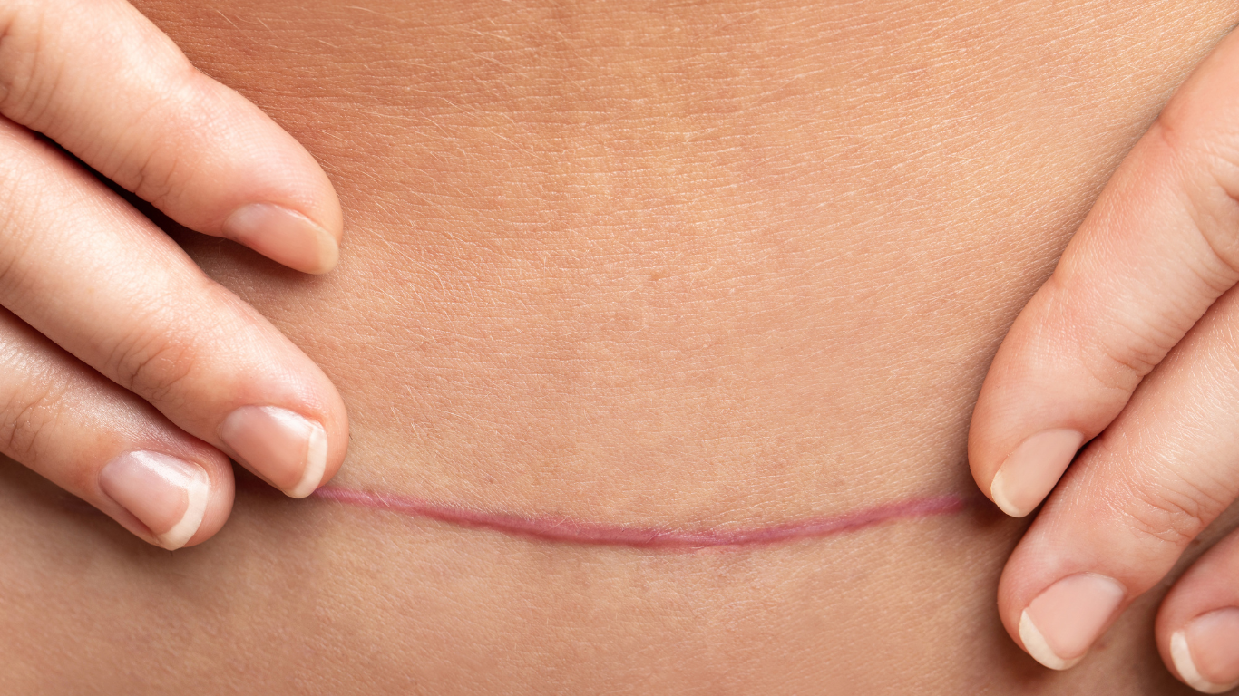Hands holding skin around a thin pink horizontal scar on the abdomen