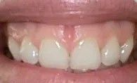 Close-up of a smiling mouth showing upper front teeth with a gap between the two center teeth