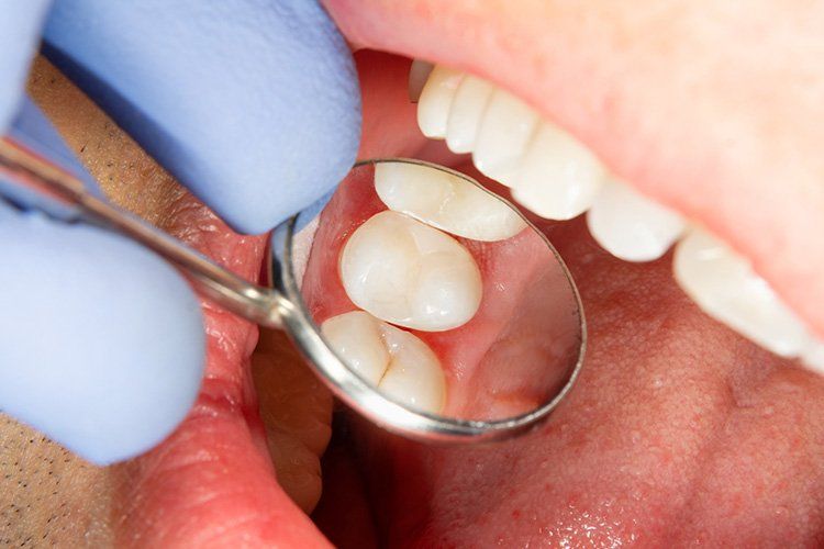 Gloved dentist using a dental mirror to examine teeth and gums inside a patient’s open mouth