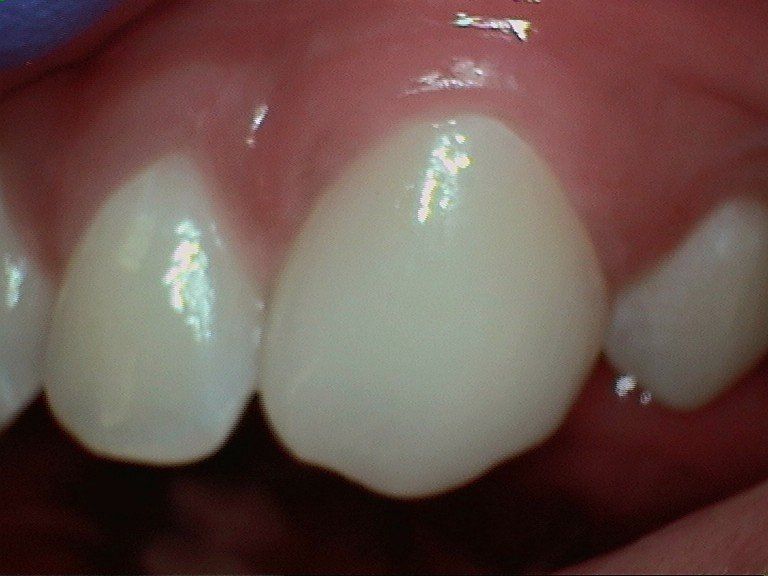 Close-up of two upper front teeth, one slightly overlapping the other, with pink gums above.