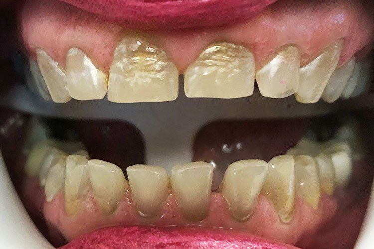 Close-up of yellowed, crooked teeth in an open mouth with pink lips.