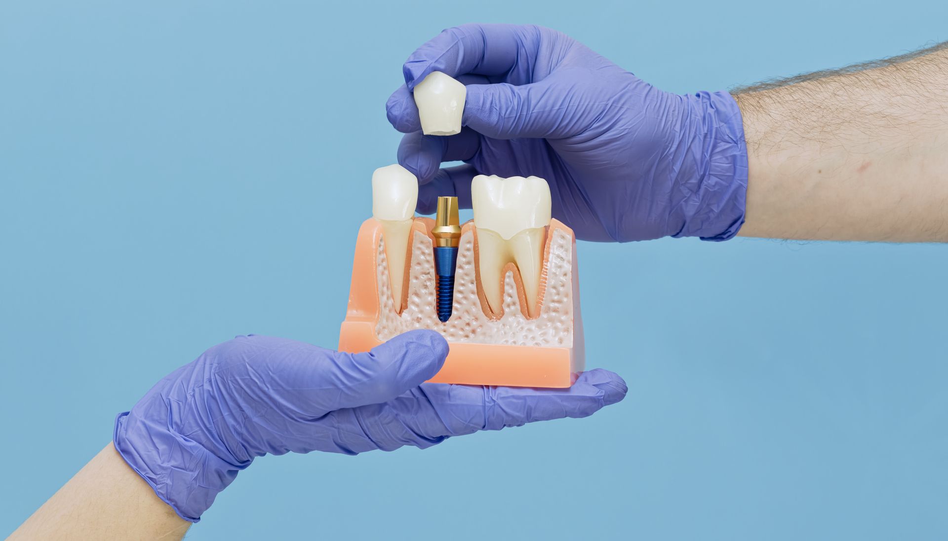 Gloved hands holding a dental implant model with a tooth and screw on a blue background
