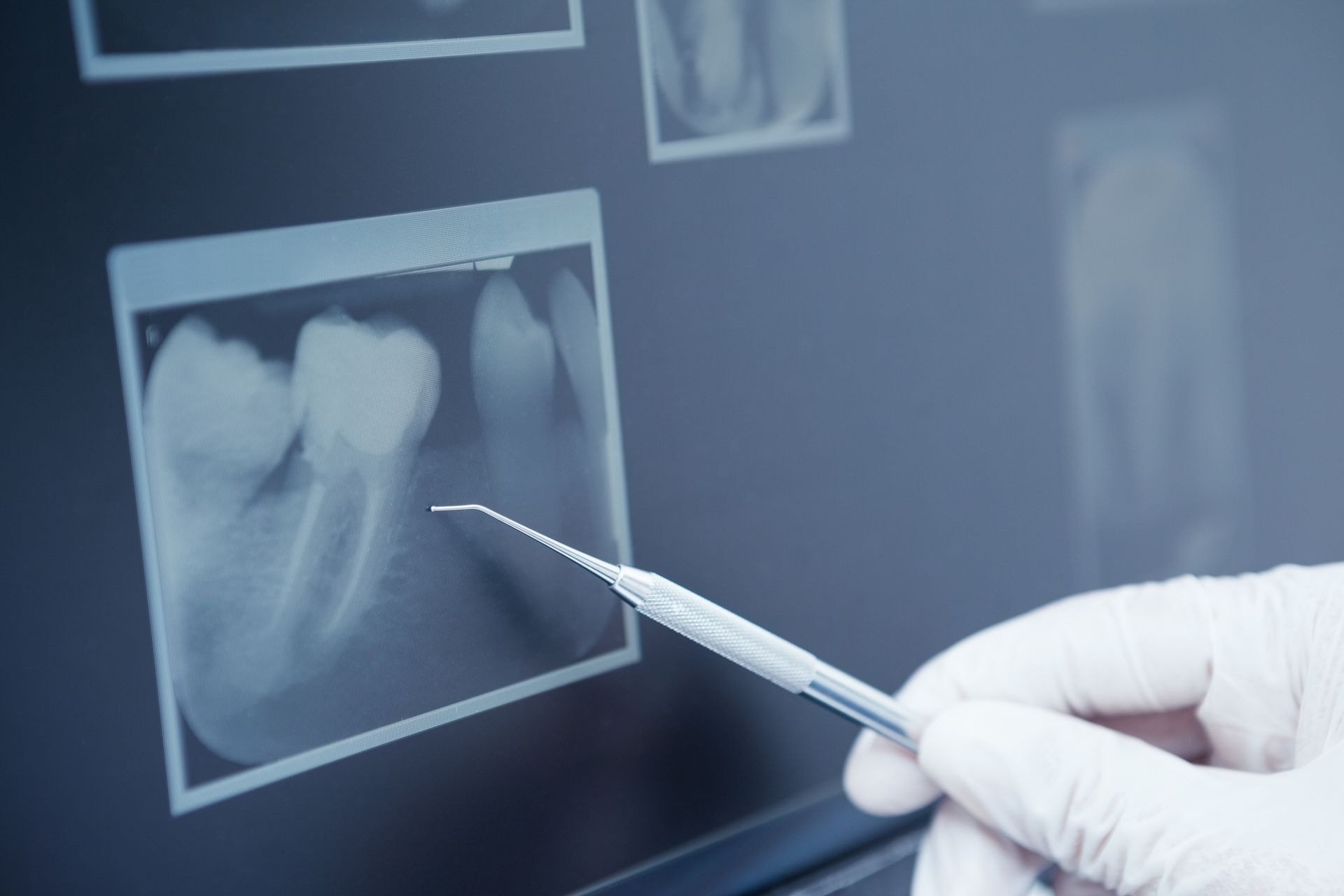 Gloved hand pointing at dental X-rays on a monitor
