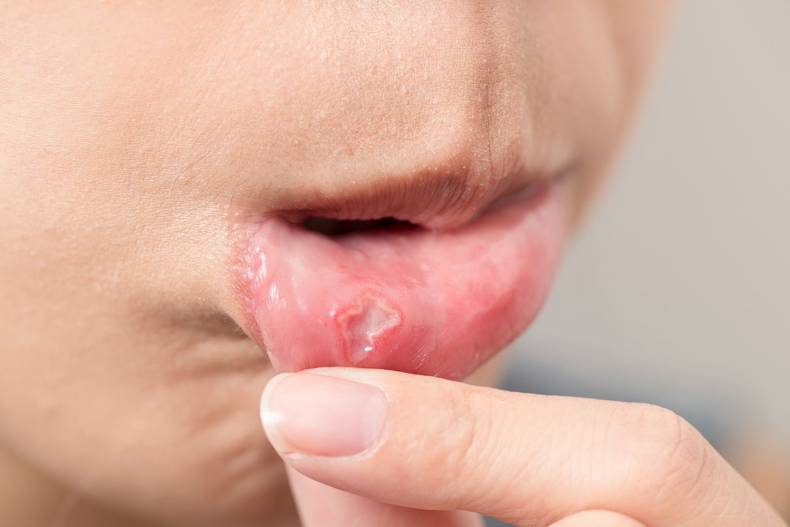 close-up-photo-of-a-mouth-aphtha