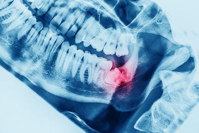 wisdom teeth removal