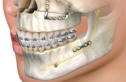 dental implants