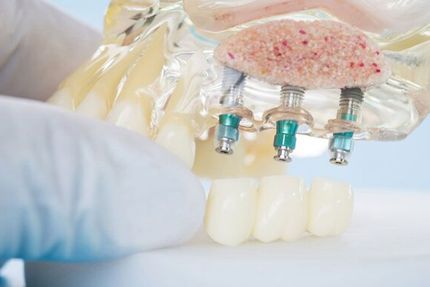 bone grafting
