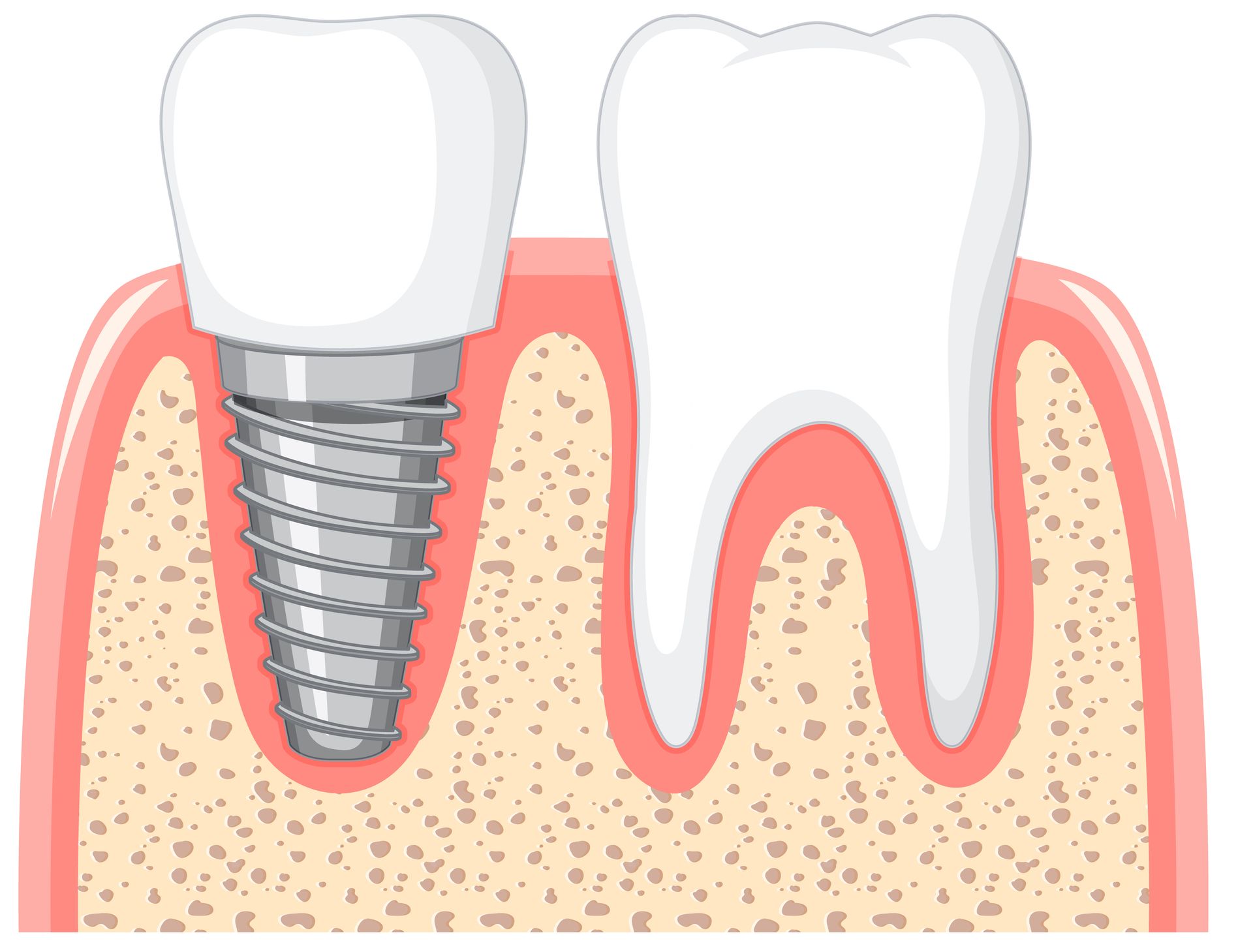 dental bone grafting