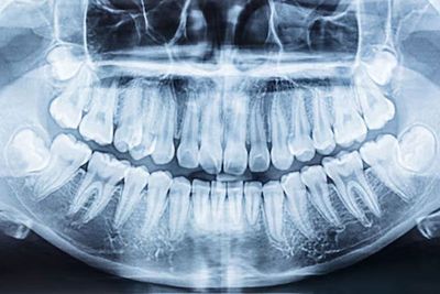 wisdom teeth removal