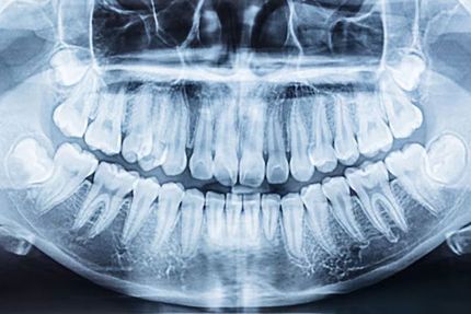 dental implants
