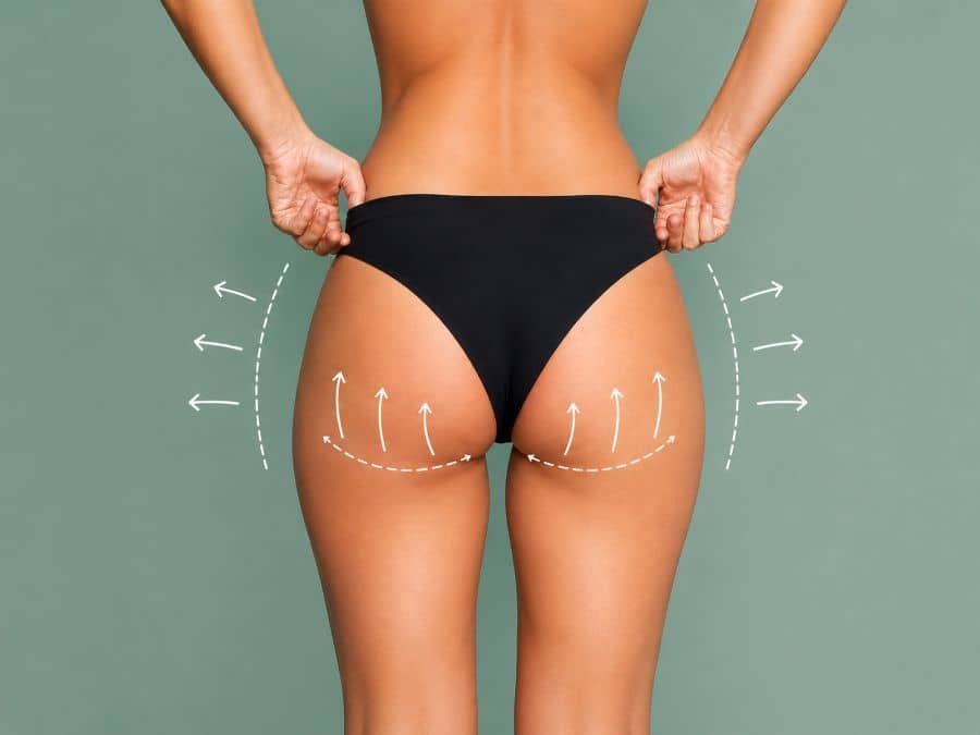 Brazilian butt lift with fat transfer
