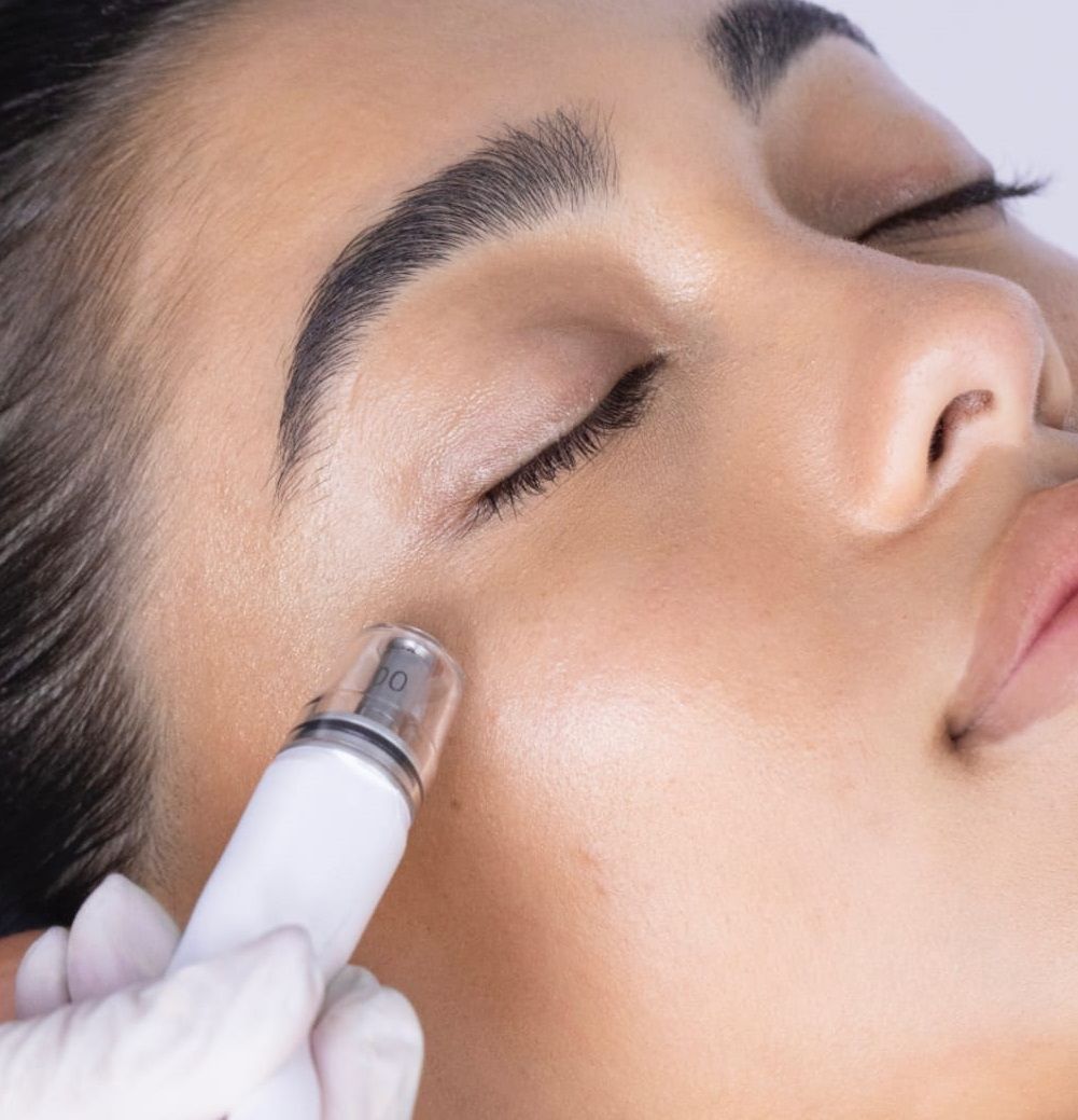 Laser skin resurfacing treatment