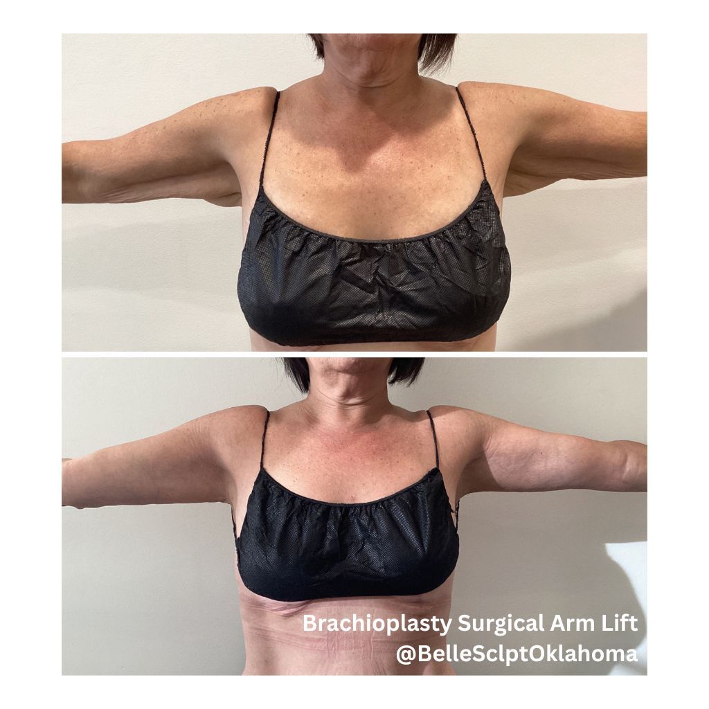 Before-and-after chest photos of a person with arms outstretched, showing post-surgery results.