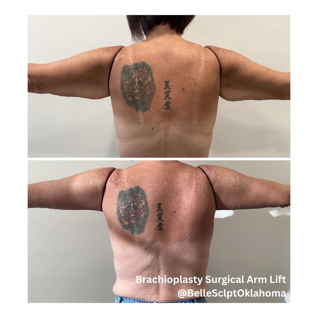 Two-panel back photo showing a large upper-back before and after brachioplasty surgery