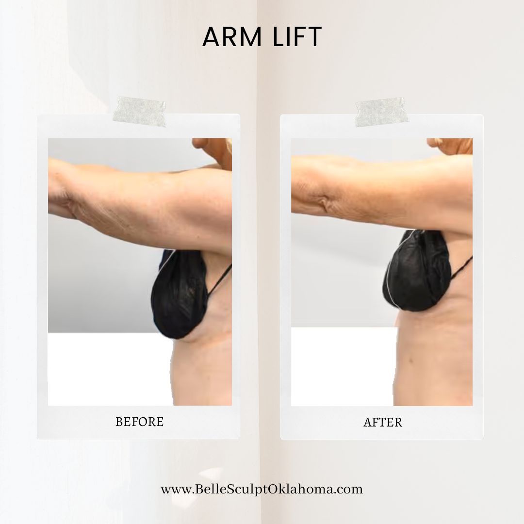 Before and after upper-arm contouring result from a BelleSculpt patient