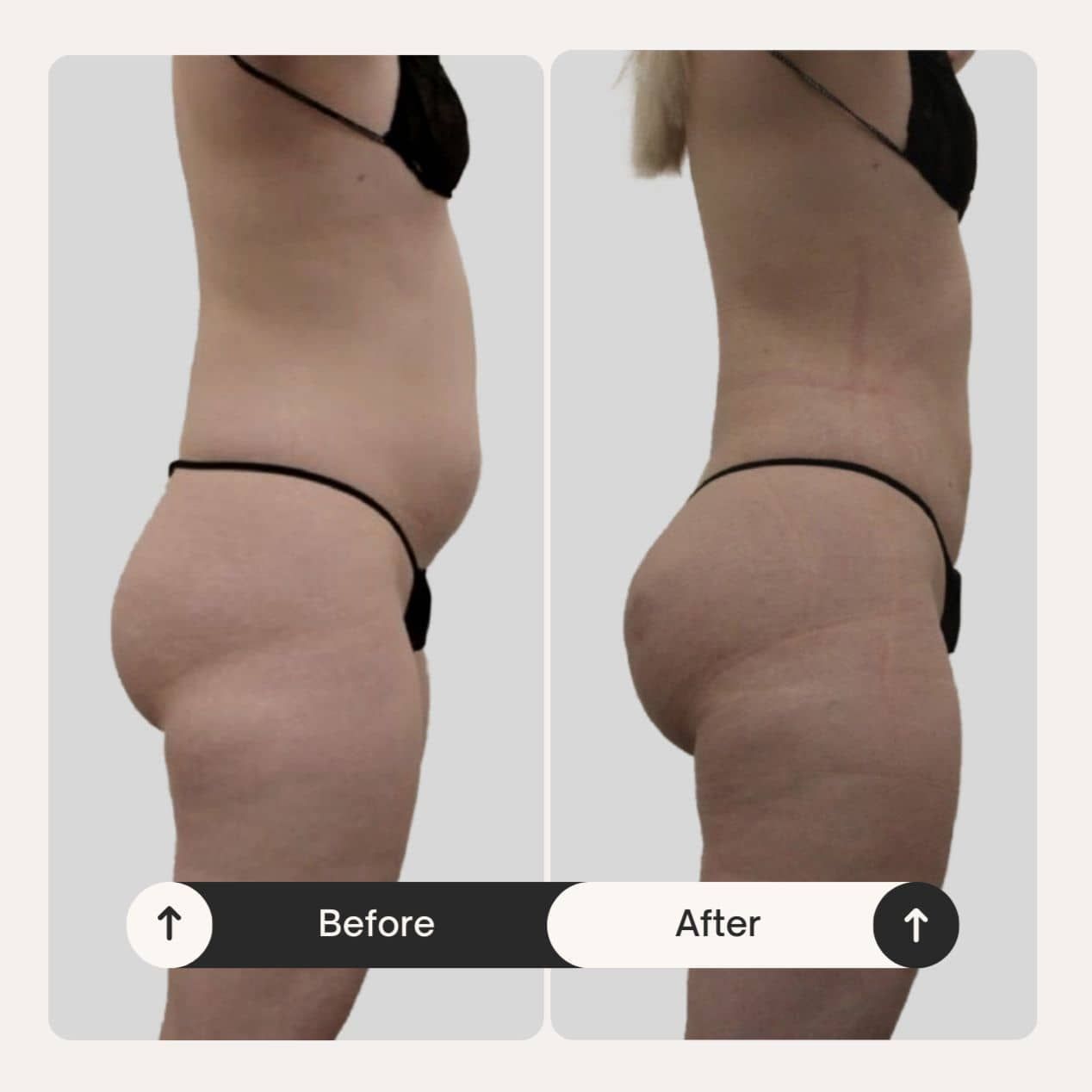 Brazilian butt lift patient before and after results