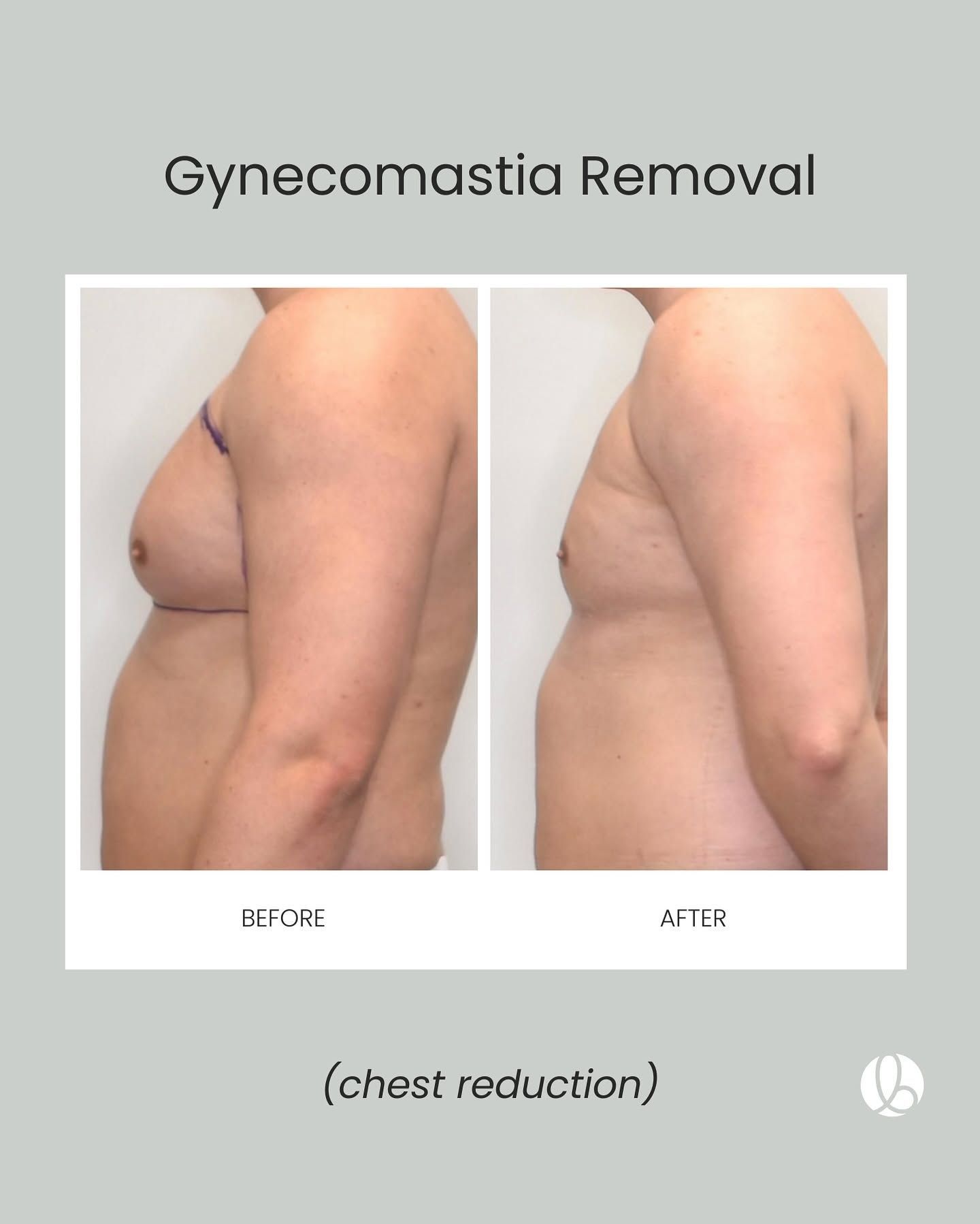 Gynecomastia removal before-and-after side-view chest photos showing reduced chest size