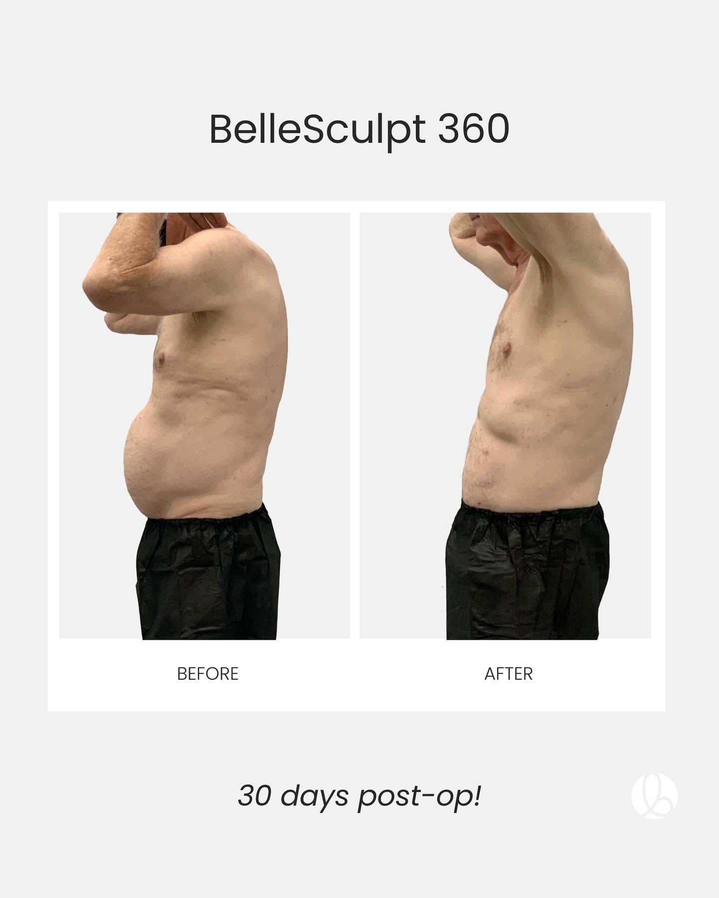 Before-and-after side-profile torso photos labeled BelleSculpt 360, showing 30 days post-op result.