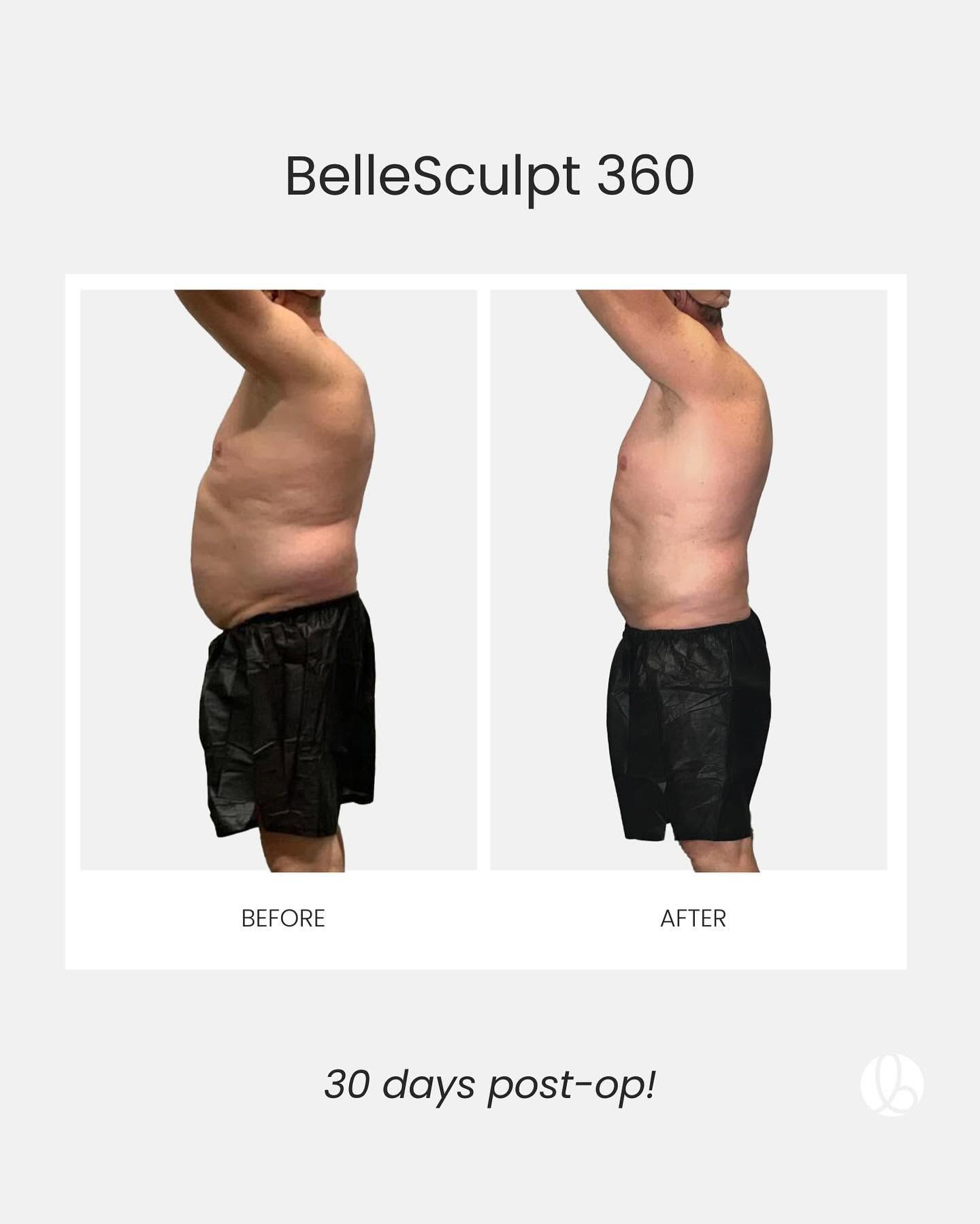 Side-by-side torso before-and-after photos labeled “BelleSculpt 360,” with “30 days post-op” at the bottom.