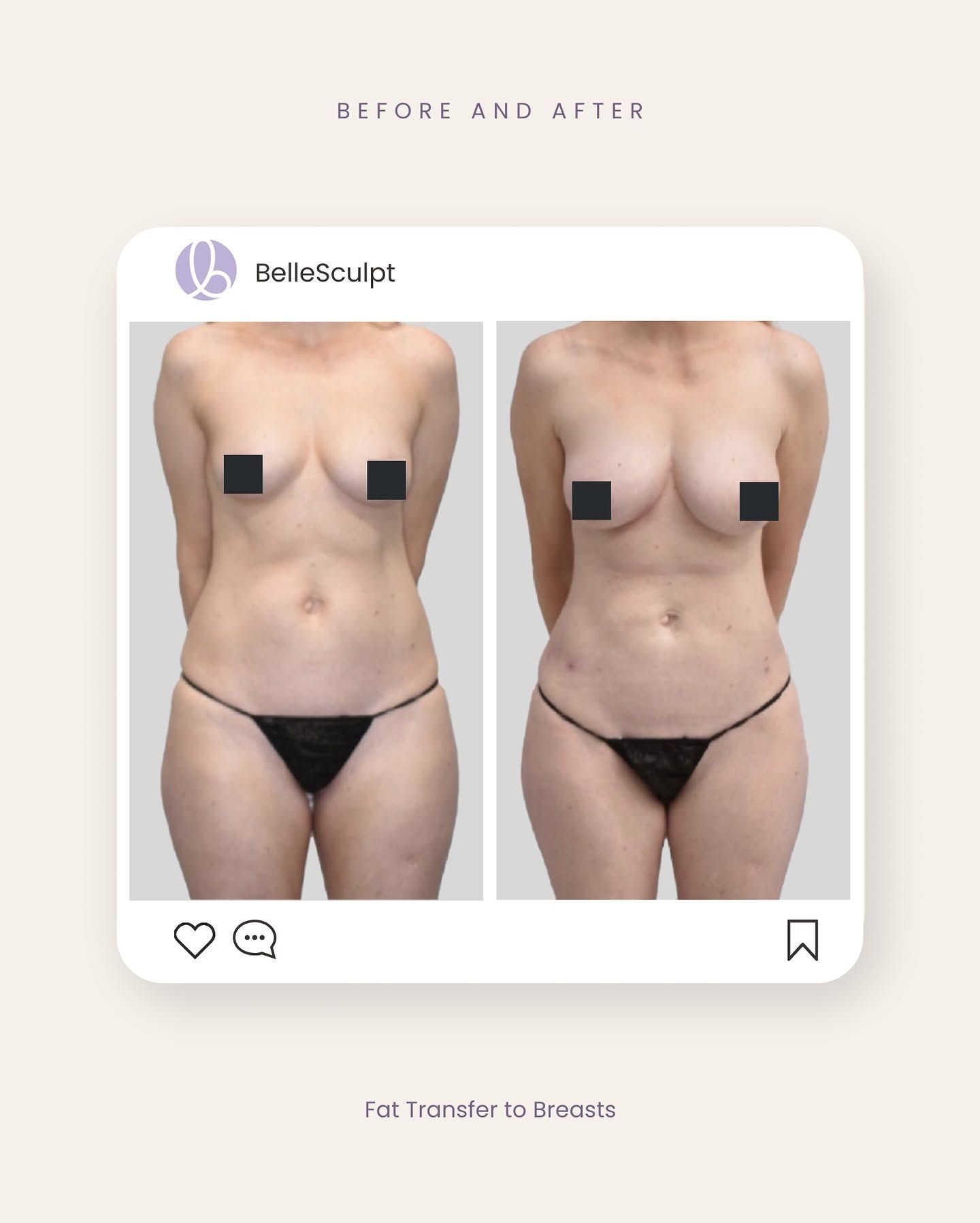 Before-and-after torso photos showing body contouring results in a social media post layout
