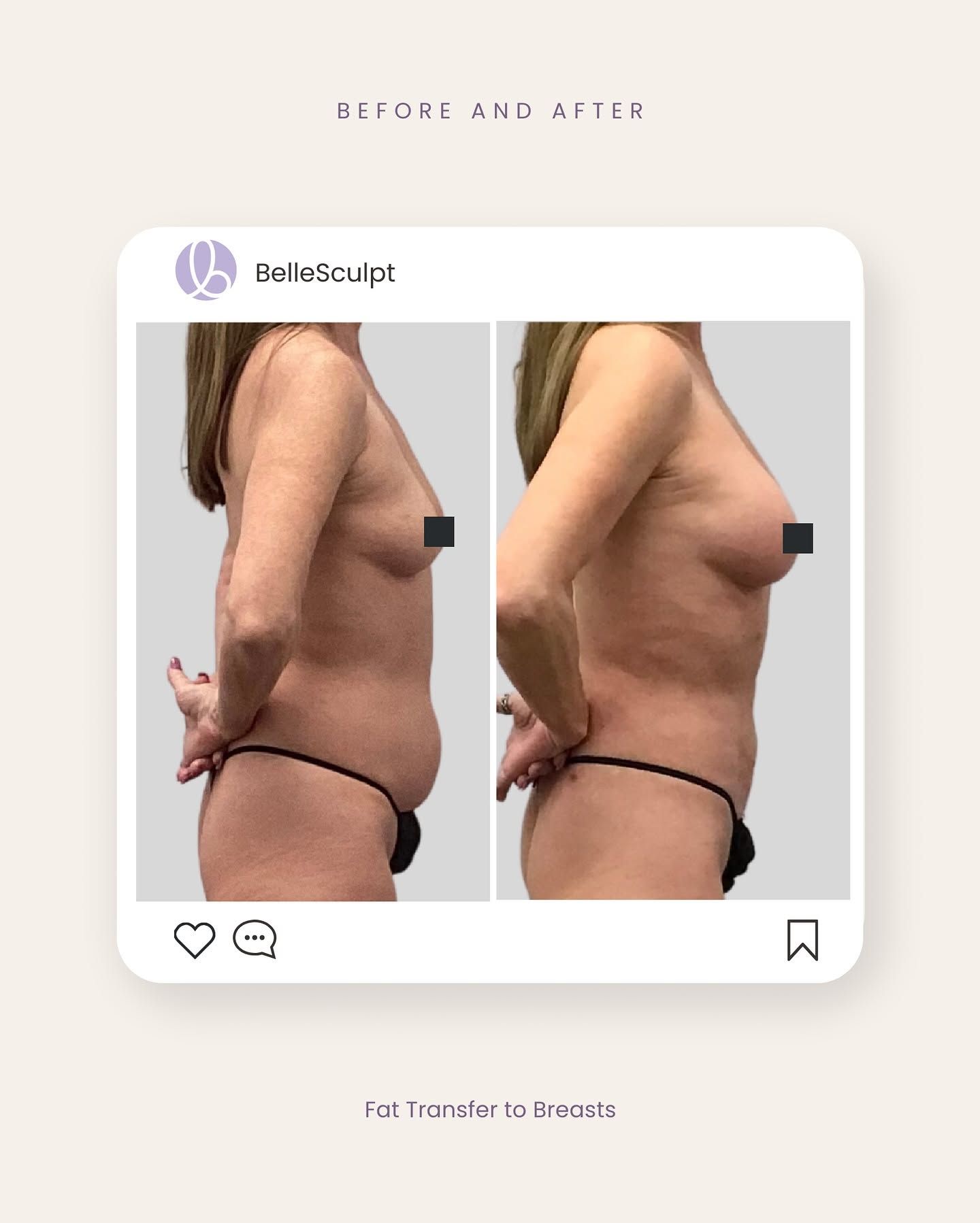 Before-and-after side view of torso showing reduced belly after body contouring treatment