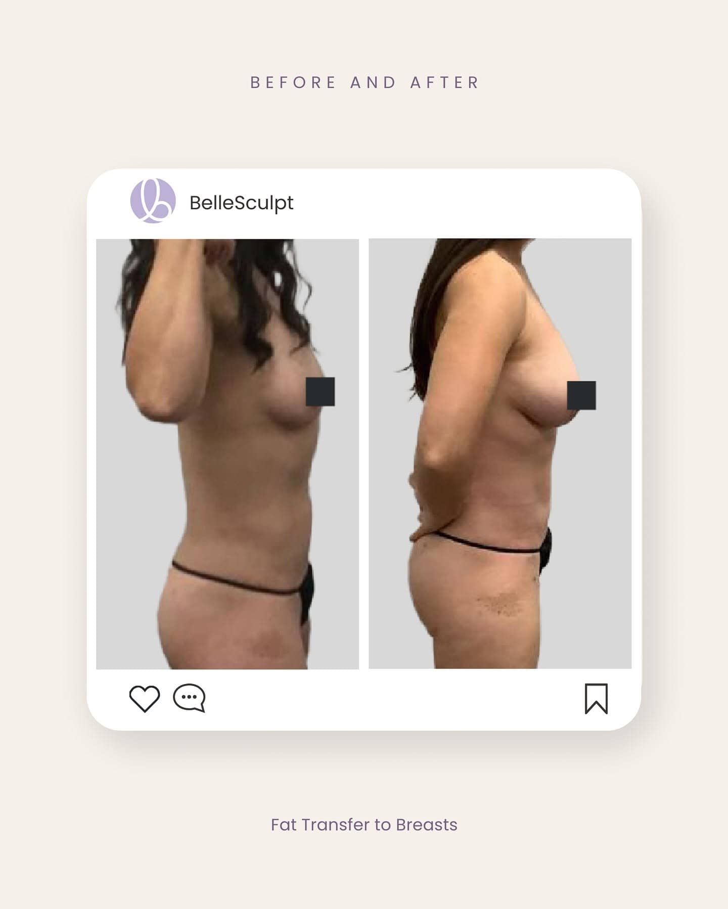 Front-view fat transfer breast augmentation before and after