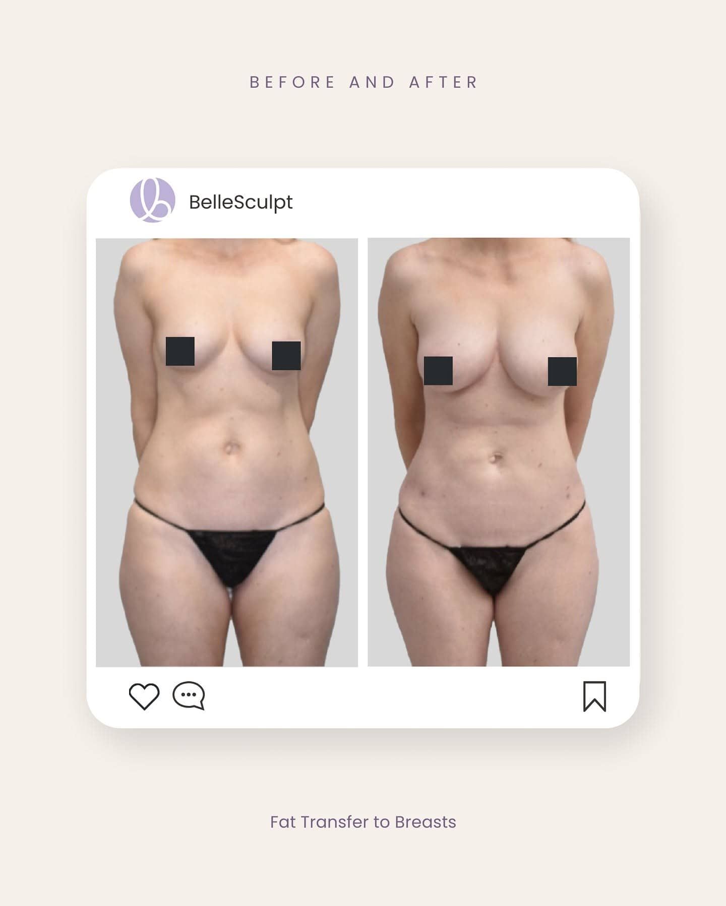 Additional fat transfer breast augmentation result