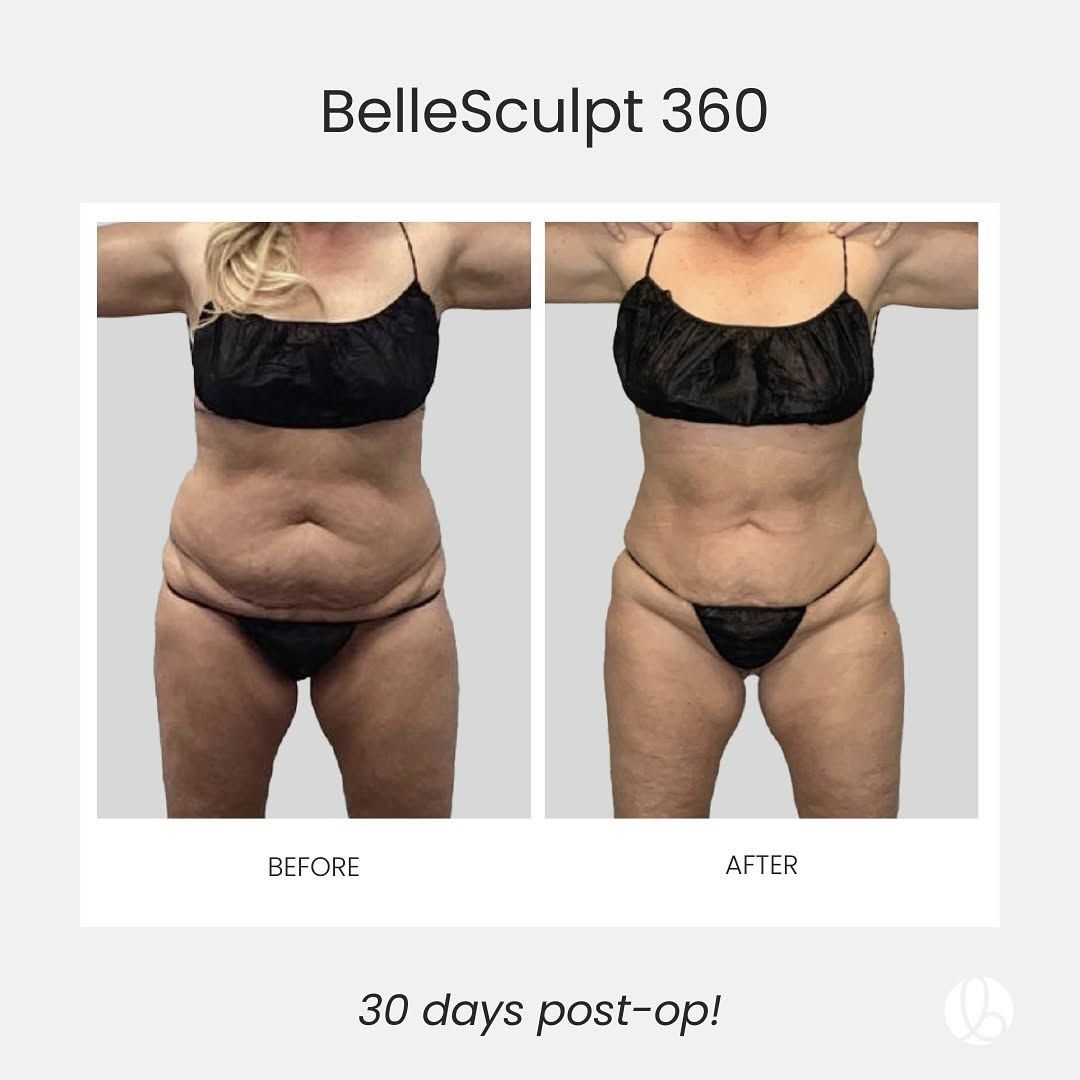 BelleSculpt 360 before-and-after torso photos, showing reduced abdominal fat after 30 days post-op.