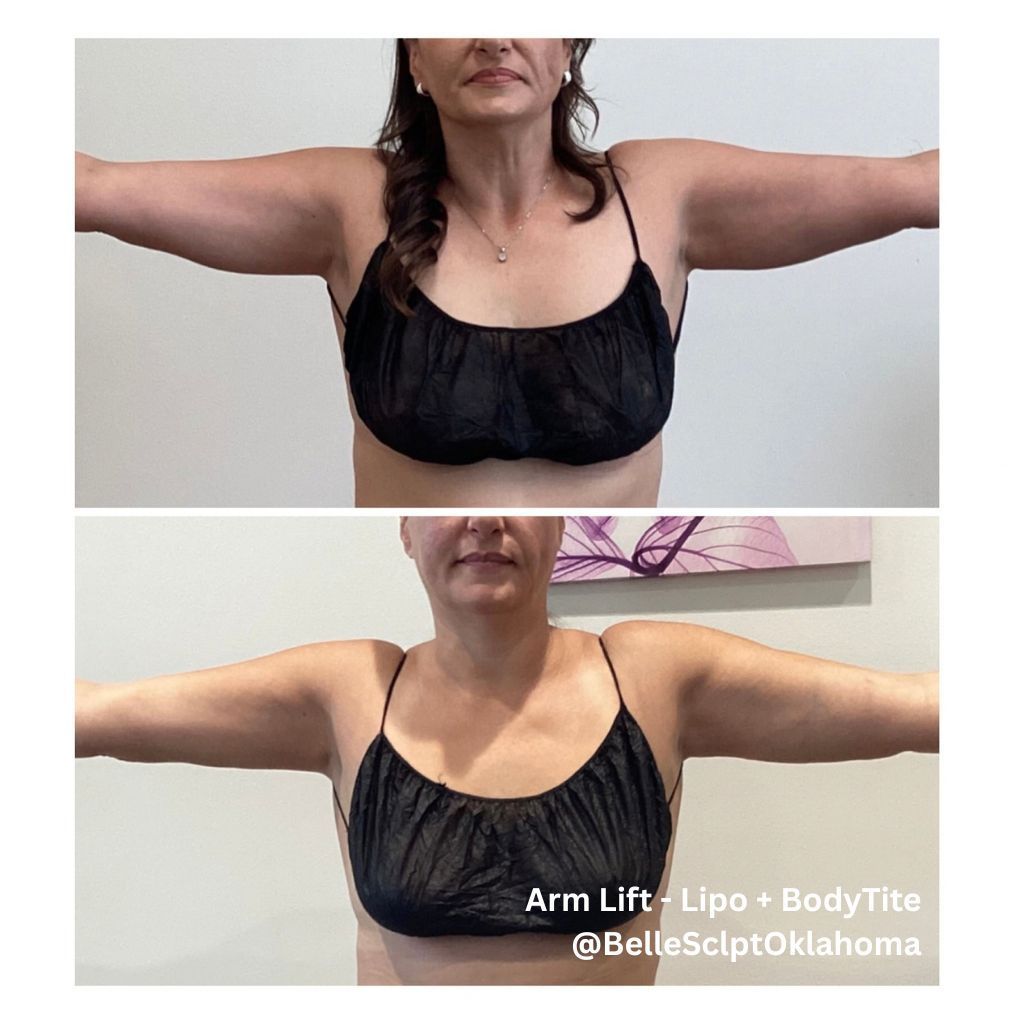 Side-by-side front views of arms outstretched, showing body shape in black tops before and after.