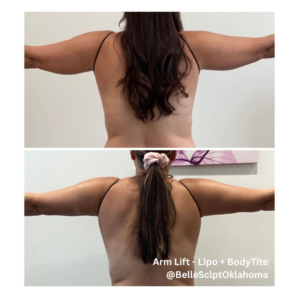 Before-and-after back view showing arms raised, with visible upper back and arm toning progress.