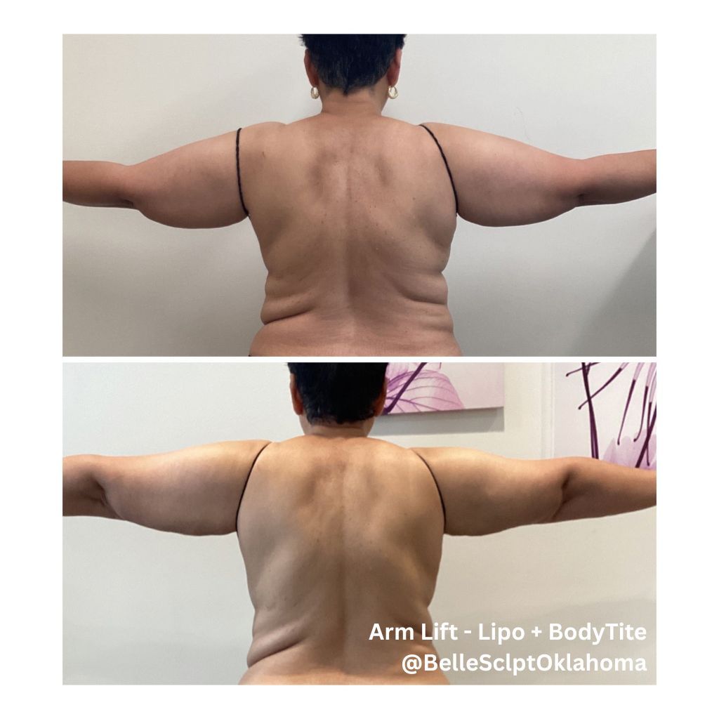 Back view of a person with arms outstretched, showing body contour changes in two comparison photos.