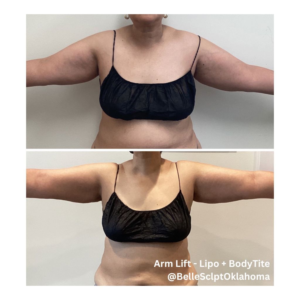 Before-and-after torso comparison in black bra, arms outstretched against a plain wall.