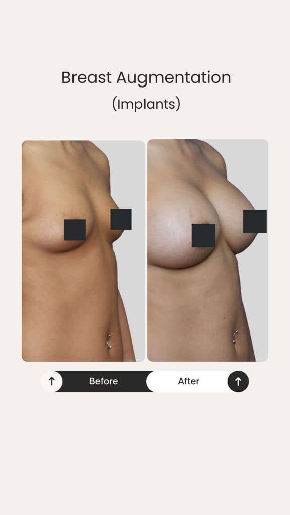 Before and after breast augmentation with implants