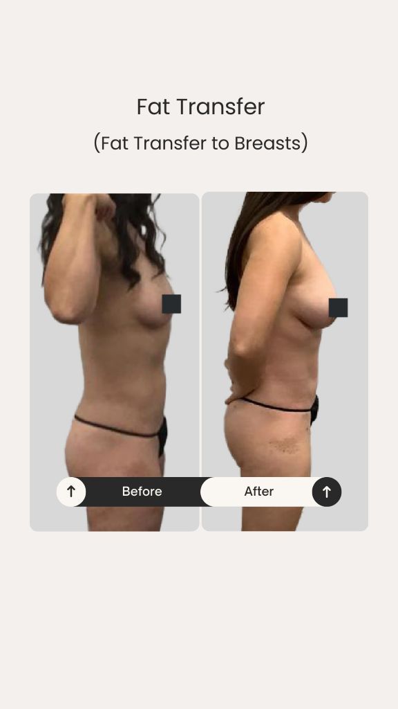 Side-view fat transfer breast augmentation before and after