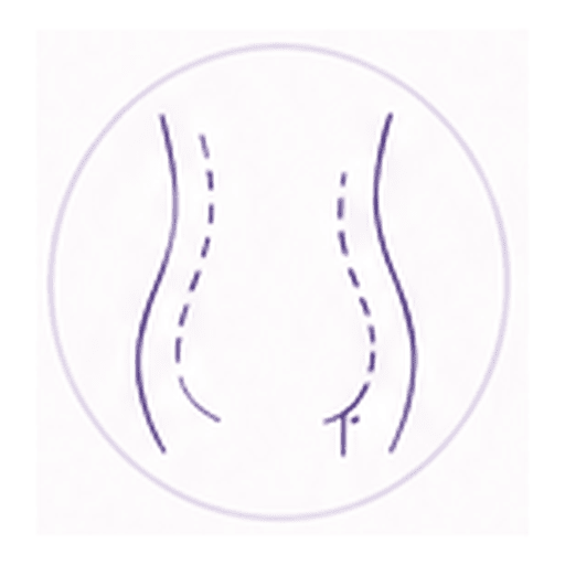 Illustration of liposuction treatment areas on the abdomen and back