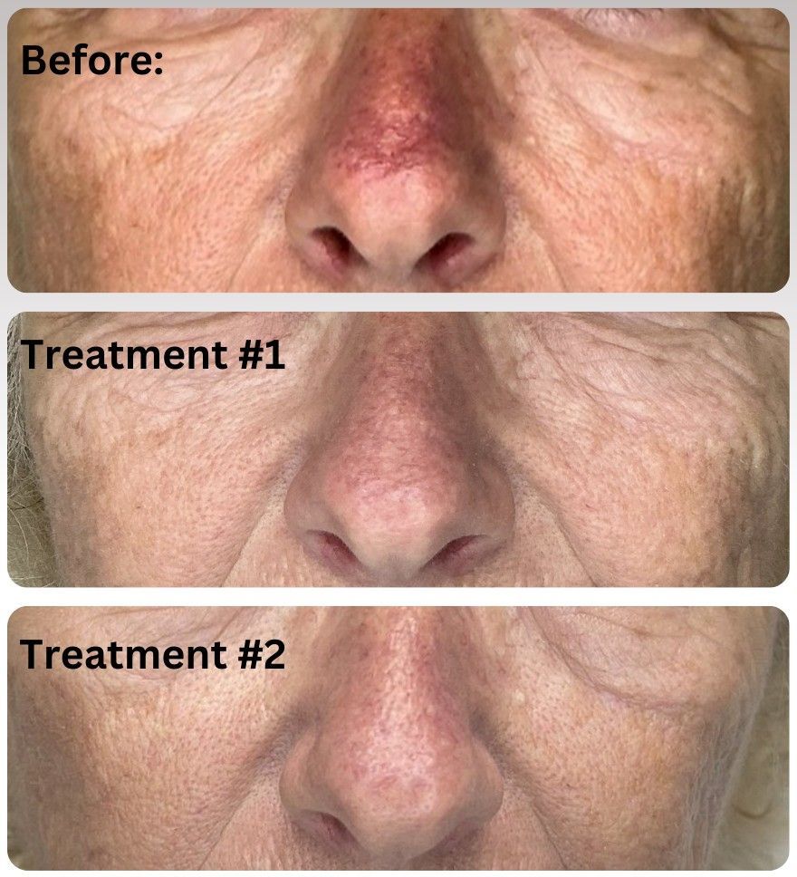 Close-ups of a patient's nose and cheeks before Lumecca, after one treatment and after two treatments, with redness fading each time