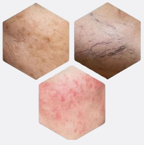 Three close-ups of skin concerns Lumecca treats: brown pigmentation, small broken vessels and redness